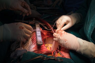 Açık kalp ameliyatı