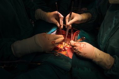 Koroner implantasyon yeniden