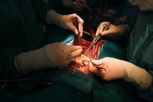 Coronary re implantation — Stock Photo, Image