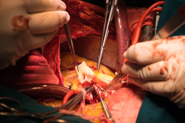 重新植入冠状动脉 — 图库照片