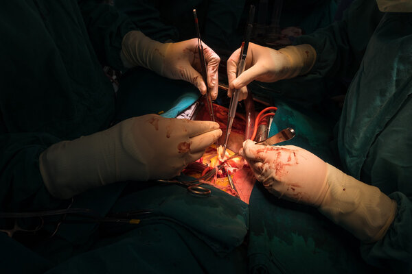 coronary re implantation