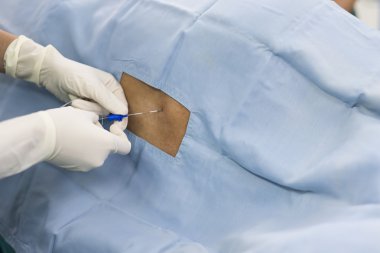 Epidural sinir bloğu.