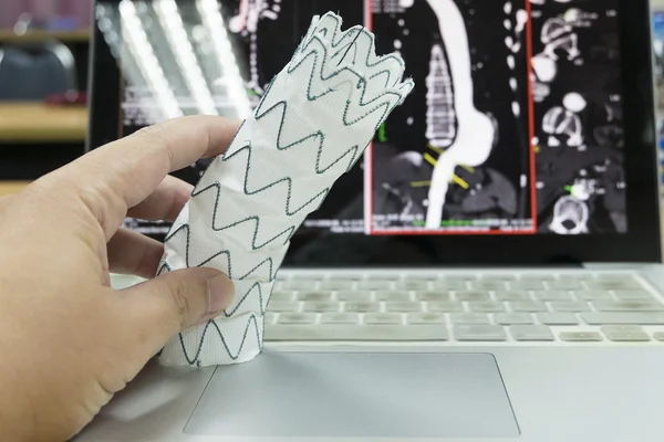 Injerto Endovascular Stent —  Fotos de Stock