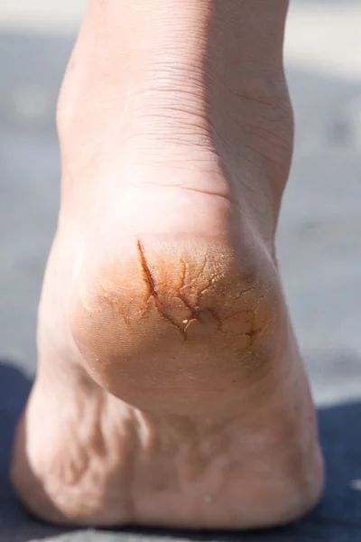 Macro photo of cracked heels. Male back view. — Stock Photo, Image