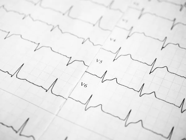 Close up of an electrocardiogram in paper form. ECG or EKG record paper. The heartbeat is shown on the graph. Medical and healthcare concept. Minimalism style template for medical blog. Soft focus — Stock Photo, Image