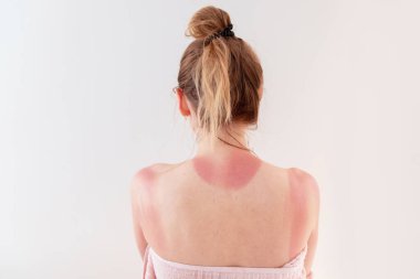 Kadınların sırtı güneşten yanar..