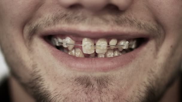 Joven con frenos en los dientes sonriendo . — Vídeos de Stock