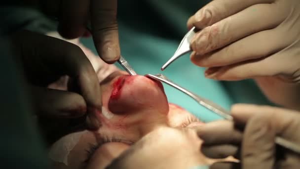 Orální a maxilofaciální chirurgie. Chirurg provádí obličejové kontury — Stock video