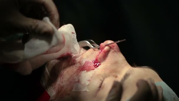 Oral och Maxillofacial kirurgi. Kirurgen gör ansiktet kontur — Stockvideo