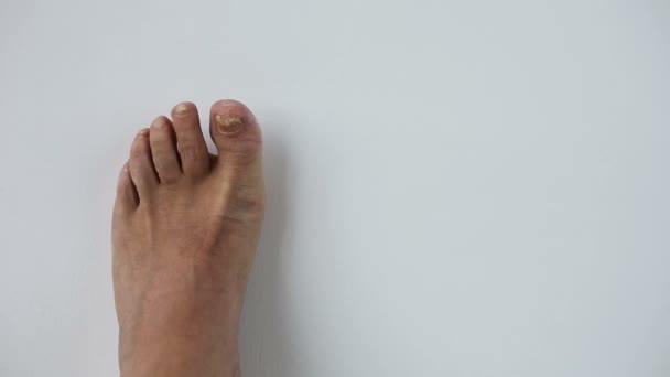 Uñas de los pies con infección fúngica — Vídeo de stock