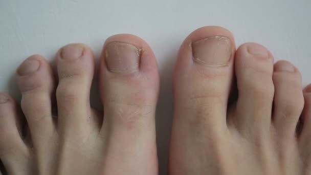 Les jeunes pieds en bonne santé vieillissent et sont malades avec des ongles d'orteils infection fongique — Video