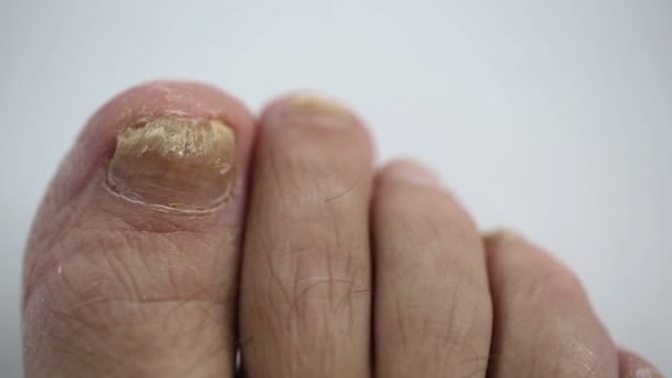 Toenails with fungal infection — Stock Video