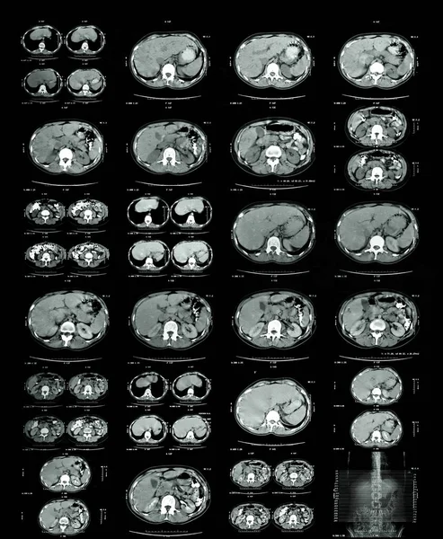 Magnetic Resonance Image of chest and thoracic spinal fusion