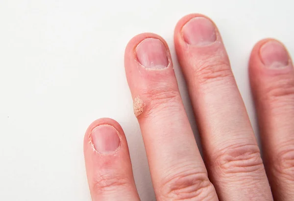 Close View Skin Disease Called Wart Caused Human Papilloma Virus — Stock Photo, Image