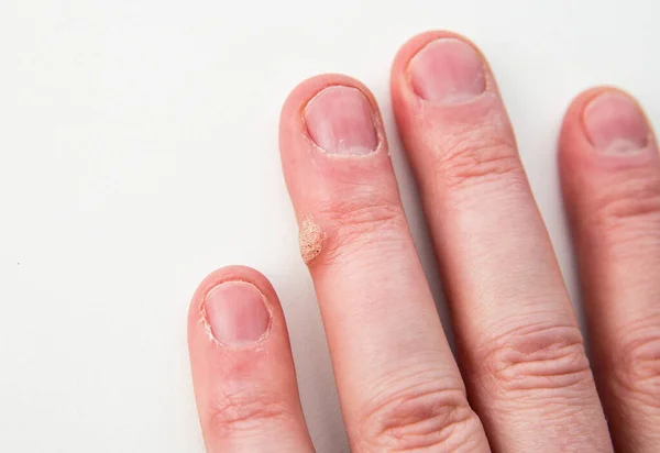 Close up view of skin disease called wart caused by human papilloma virus on human finger.