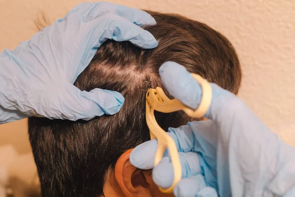 doctor or nurse with surgical gloves using staple remover scissors to remove stitches from a gap or head wound with selective focus