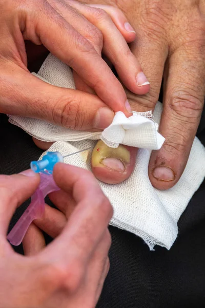 Médico Practicando Una Punción Con Aguja Dedo Infectado Por Una — Foto de Stock
