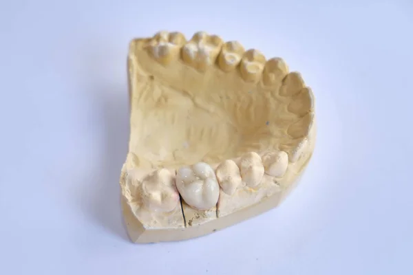 Aparelhos Dentários Próteses Dentárias — Fotografia de Stock