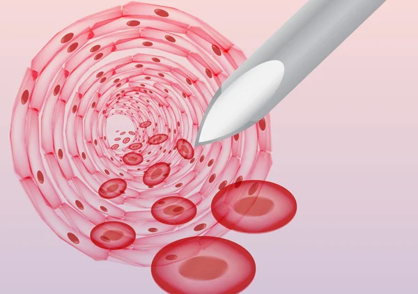 Inyección en el torrente sanguíneo con una jeringa desde el interior - Ilustración vectorial — Vector de stock