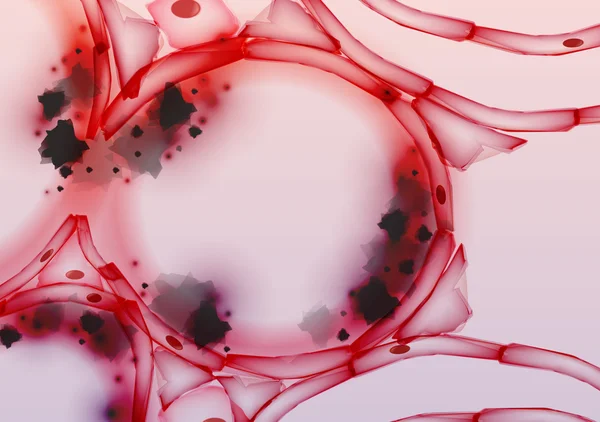 Entzündete Lungenbläschen in Lungengewebeschnitten, Querschnitt, Rauchteer - Vektorillustration — Stockvektor
