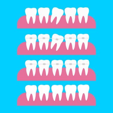 Ortodontik diş telleriyle yapılan diş düzeltmeleri. Diş ortodontik tedavi vektör çizimi. Diş teli düzeltme kavramından önce ve sonra