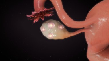 IVF kadın folikül aspirasyon.