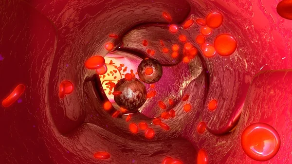 Tumor cells in blood vessels — Stock Photo, Image