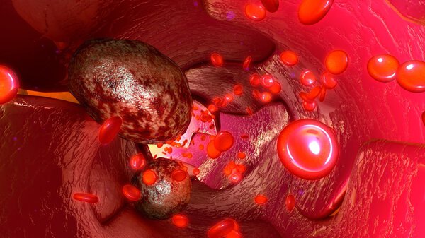 Tumor cells in blood vessels