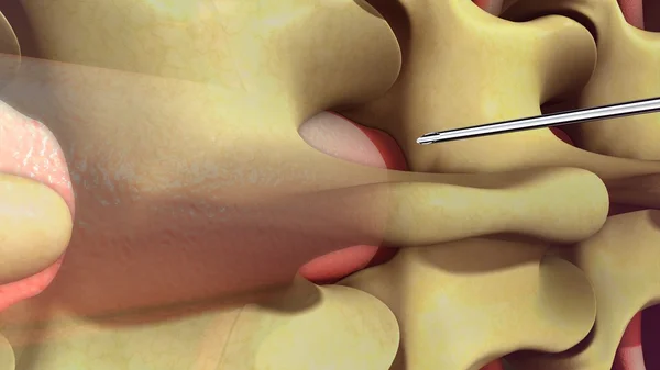 Внутрішній вигляд спинномозкової анестезії — стокове фото