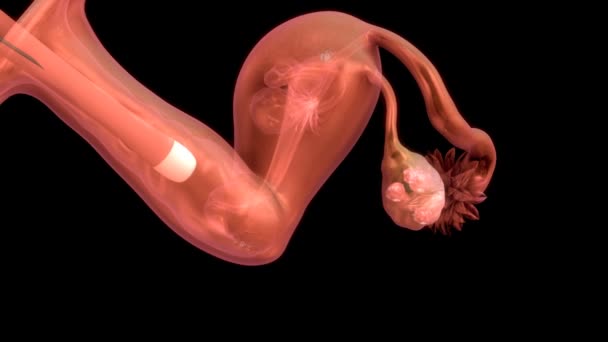 女性卵胞吸引 — ストック動画
