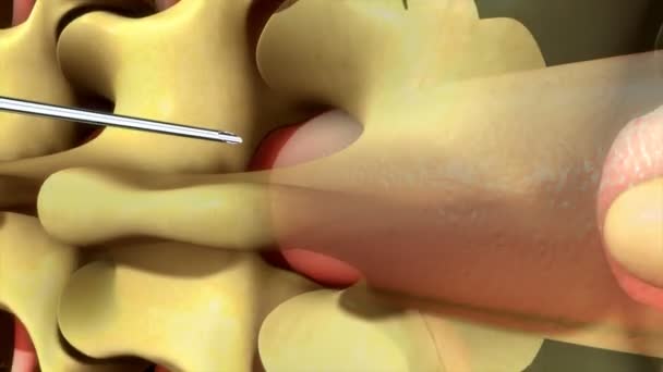 Spinale en epidurale anesthesie — Stockvideo