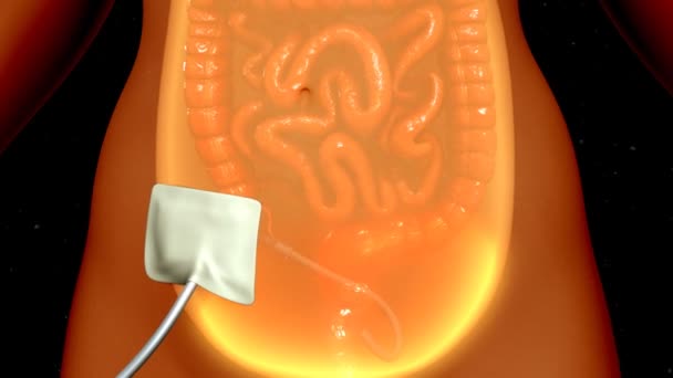 Peritoneal dialys processen — Stockvideo