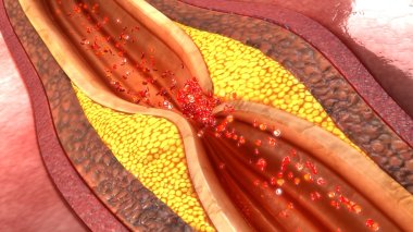 coronary artery plaque clipart