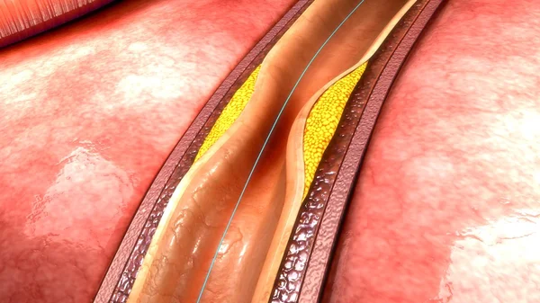 Endoprothèse dans le vaisseau sanguin humain — Photo
