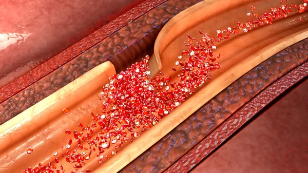 Рассечение коронарной артерии — стоковое фото