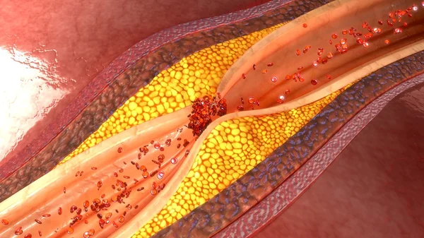 Почетная доска коронарной артерии — стоковое фото