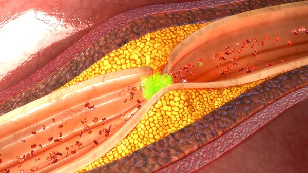 Blood vessel Thrombolytic therapy — Stock Photo, Image
