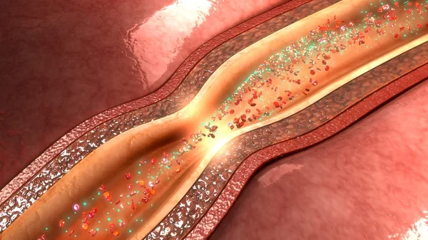 Relajación de la arteria coronaria —  Fotos de Stock