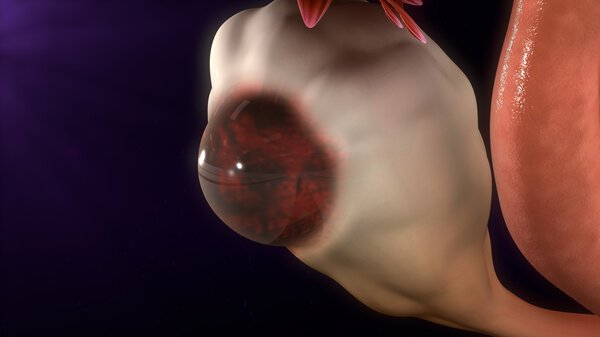 Endometrioma cystic mass