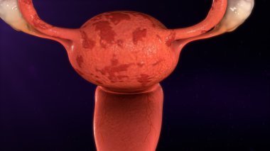 uterus endometriosis disease clipart