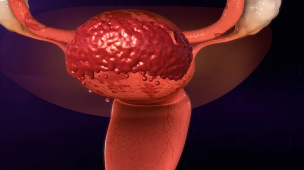 Uterus endometriosis disease — Stock Photo, Image