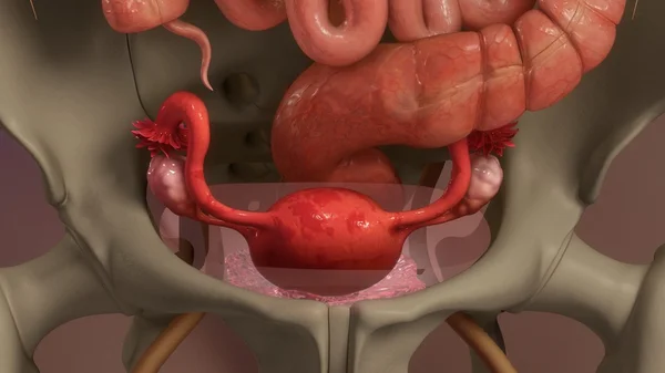 Malattia dell'endometriosi dell'utero — Foto Stock