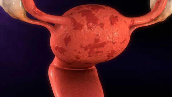 Endometrioza uterului — Fotografie, imagine de stoc