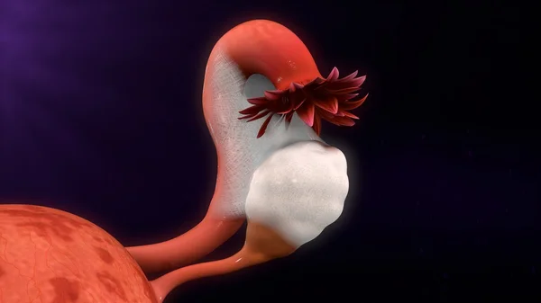 Uterus-Endometriose — Stockfoto