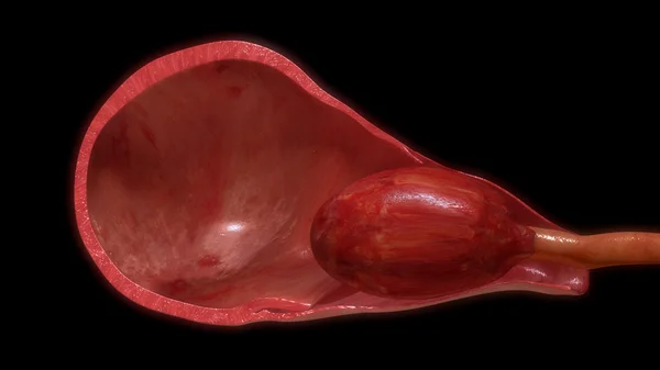Tirar a placenta do útero — Fotografia de Stock