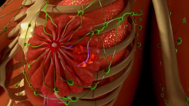 Metastasi del cancro al seno — Video Stock