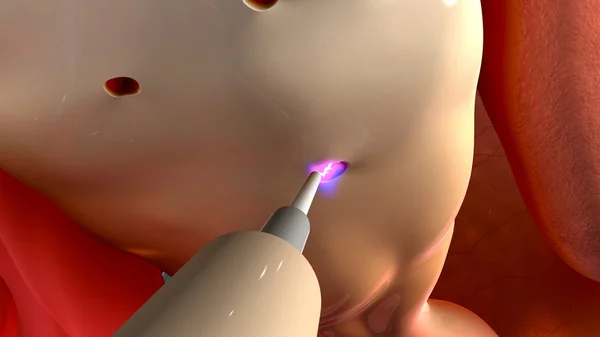 Laparoscopic Ovarian Drilling — Stock Photo, Image
