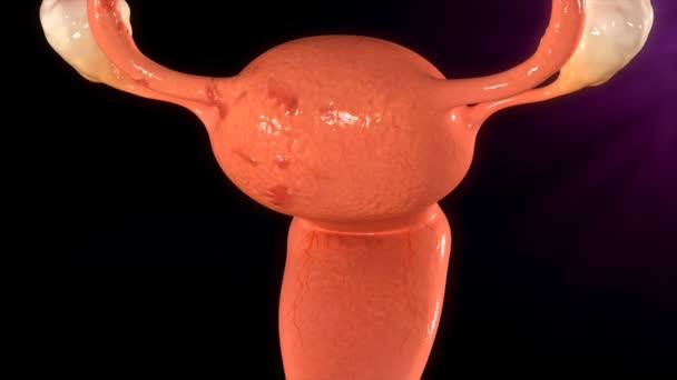 Rimozione del tessuto endometriale sugli organi femminili — Video Stock