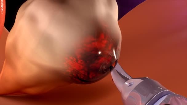 Human ovarian cyst — Stock Video