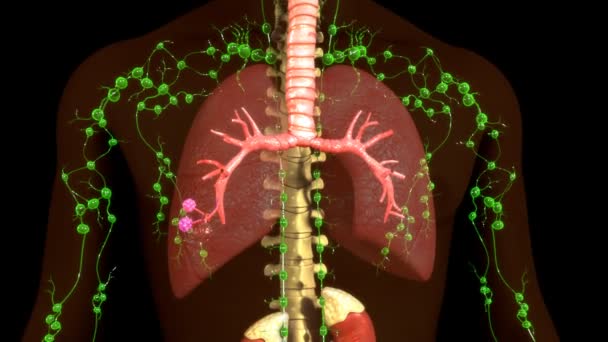 Granulombildning i mänsklig lunga — Stockvideo
